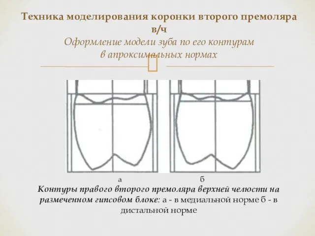 Контуры правого второго премоляра верхней челюсти на размеченном гипсовом блоке: а