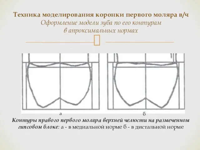 Контуры правого первого моляра верхней челюсти на размеченном гипсовом блоке: а