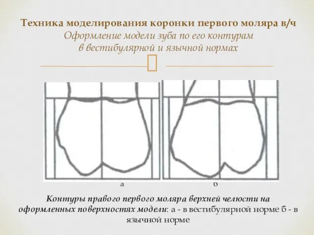 Контуры правого первого моляра верхней челюсти на оформленных поверхностях модели: а