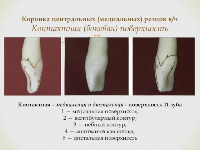 Коронка центральных (медиальных) резцов в/ч Контактная (боковая) поверхность Контактная – медиальная