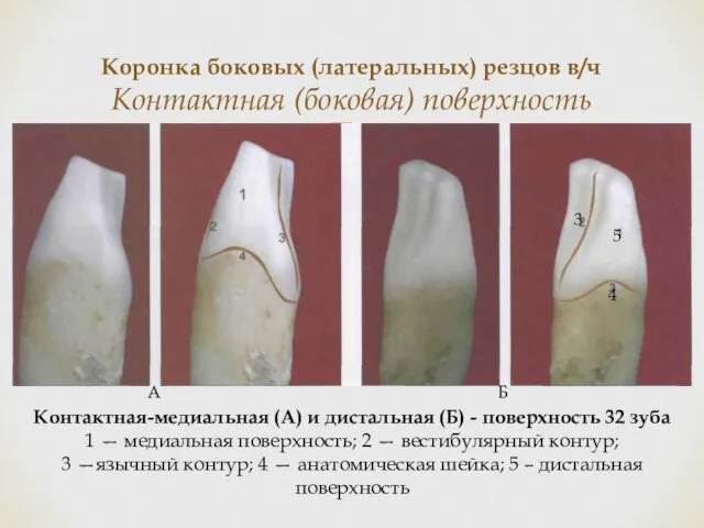 Коронка боковых (латеральных) резцов в/ч Контактная (боковая) поверхность Контактная-медиальная (А) и