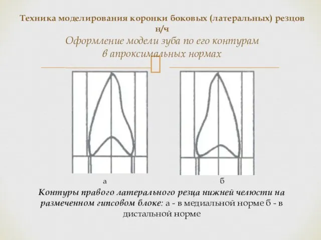 Контуры правого латерального резца нижней челюсти на размеченном гипсовом блоке: а