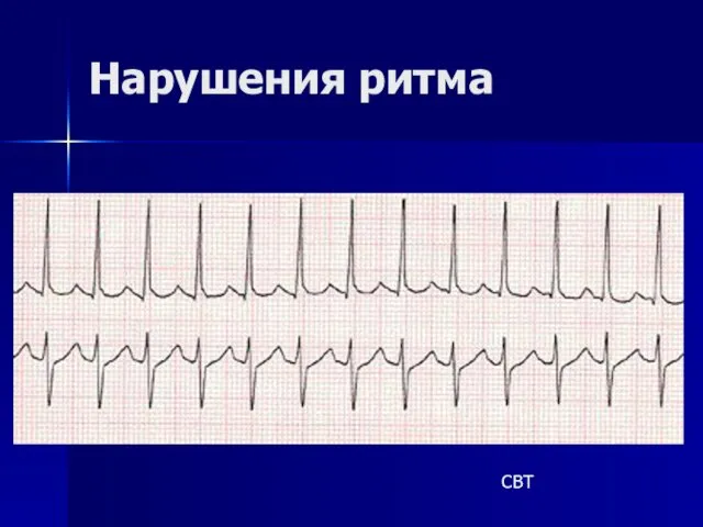 Нарушения ритма СВТ