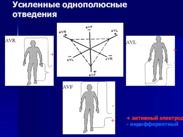 + + - - + - Усиленные однополюсные отведения + активный электрод - индифферентный