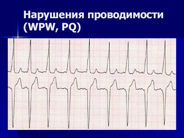 Нарушения проводимости (WPW, PQ)