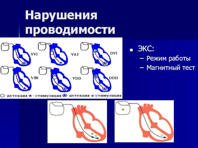 Нарушения проводимости ЭКС: Режим работы Магнитный тест