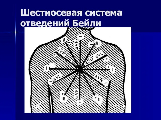 Шестиосевая система отведений Бейли