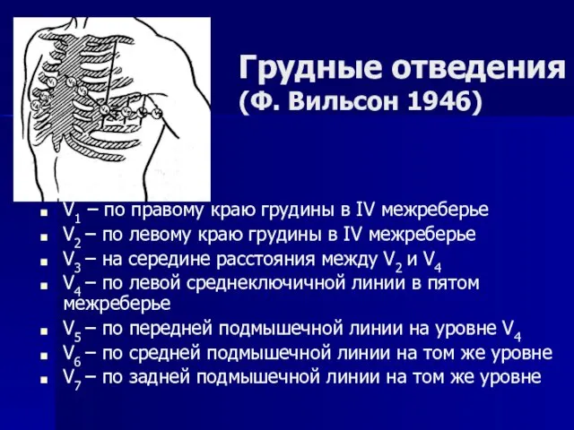 Грудные отведения (Ф. Вильсон 1946) V1 – по правому краю грудины