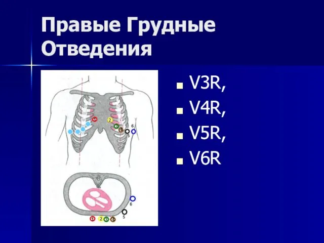 Правые Грудные Отведения V3R, V4R, V5R, V6R