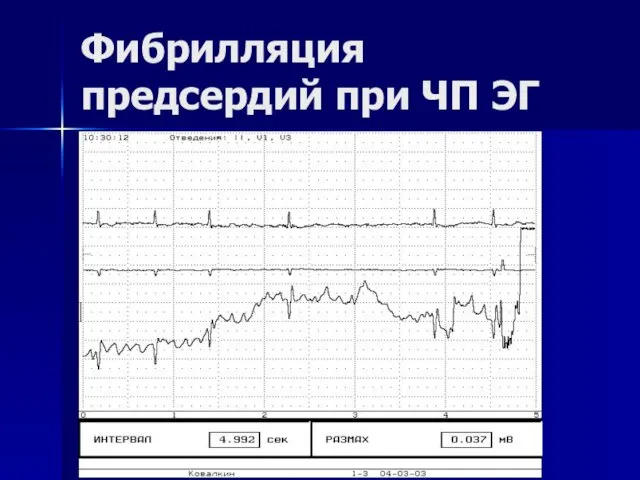 Фибрилляция предсердий при ЧП ЭГ