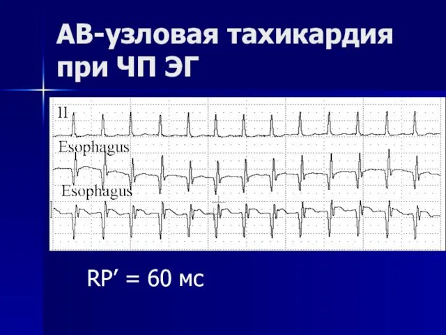 АВ-узловая тахикардия при ЧП ЭГ RP’ = 60 мс