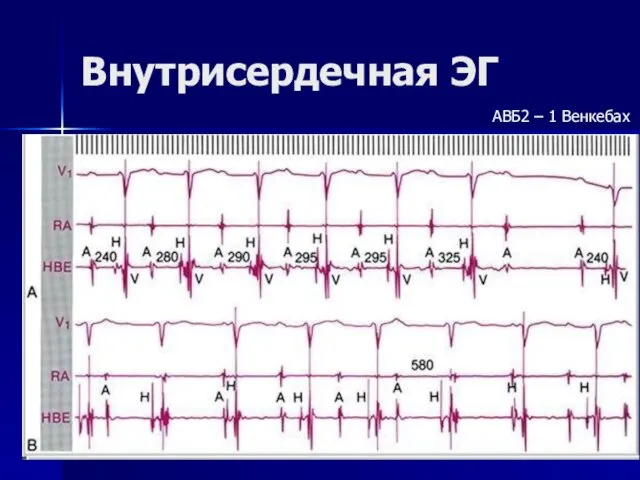 Внутрисердечная ЭГ АВБ2 – 1 Венкебах