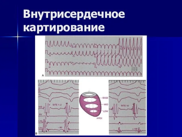 Внутрисердечное картирование