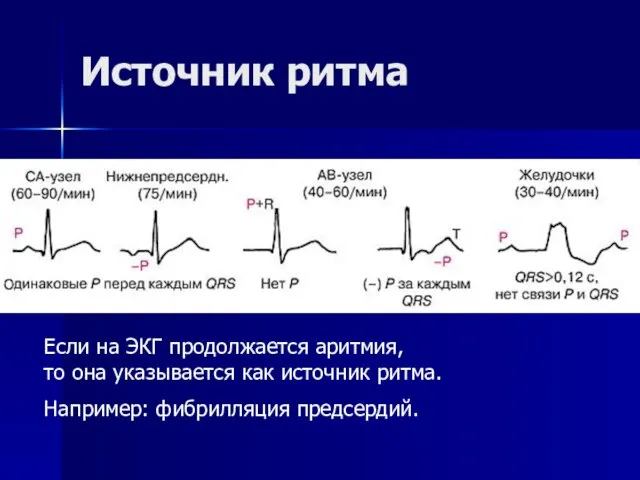 Источник ритма Если на ЭКГ продолжается аритмия, то она указывается как источник ритма. Например: фибрилляция предсердий.