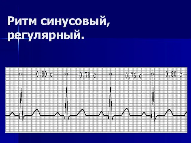 Ритм синусовый, регулярный.