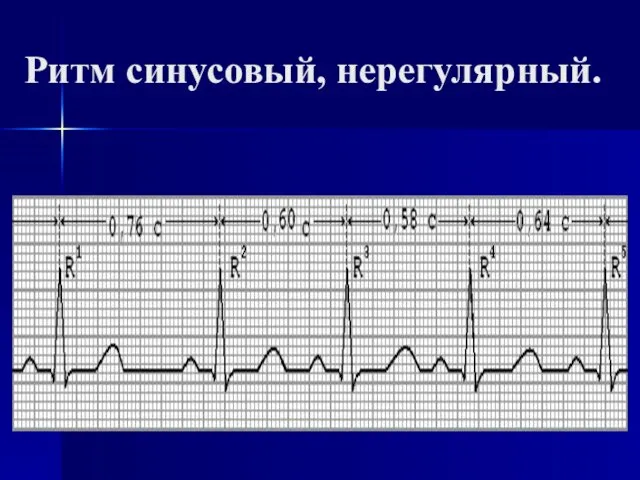 Ритм синусовый, нерегулярный.