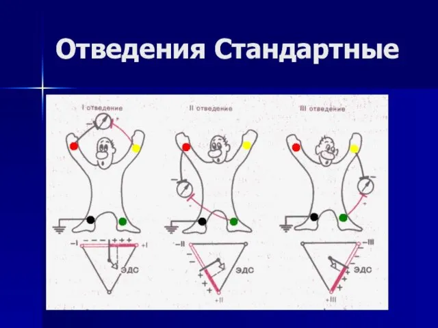 Отведения Стандартные