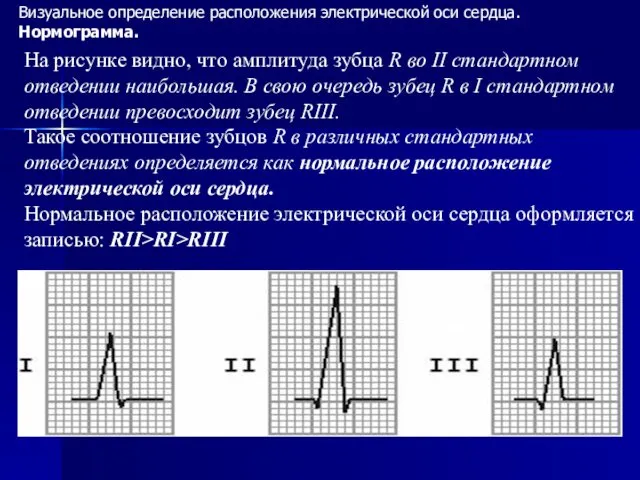 Визуальное определение расположения электрической оси сердца. Нормограмма. На рисунке видно, что