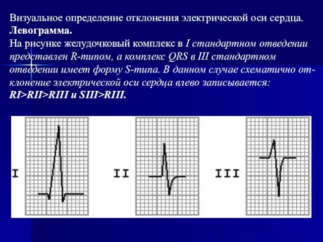 Визуальное определение отклонения электрической оси сердца. Левограмма. На рисунке желудочковый комплекс