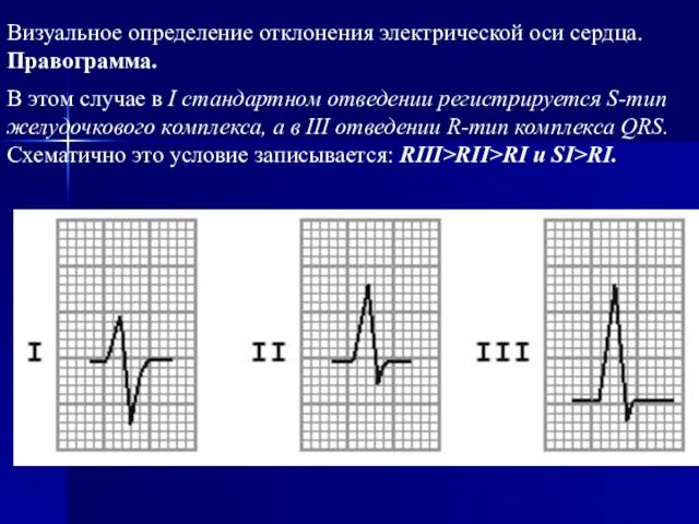 Визуальное определение отклонения электрической оси сердца. Правограмма. В этом случае в