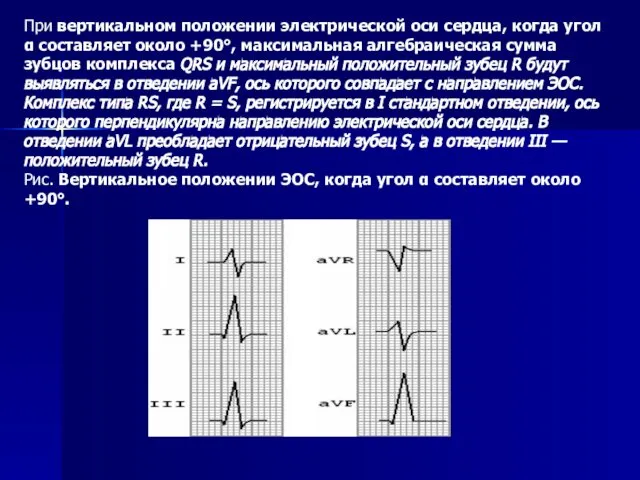 При вертикальном положении электрической оси сердца, когда угол α составляет около