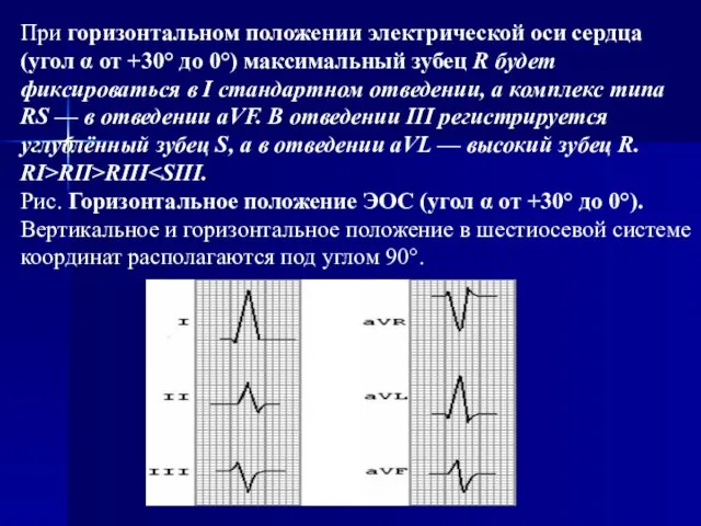 При горизонтальном положении электрической оси сердца (угол α от +30° до