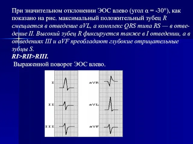 При значительном отклонении ЭОС влево (угол α = -30°), как показано