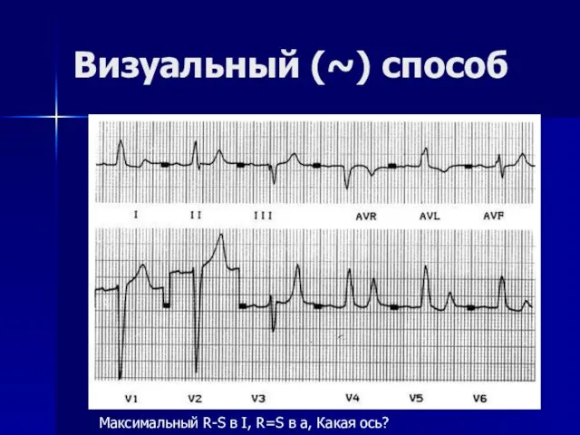 Визуальный (~) способ Максимальный R-S в I, R=S в а, Какая ось?