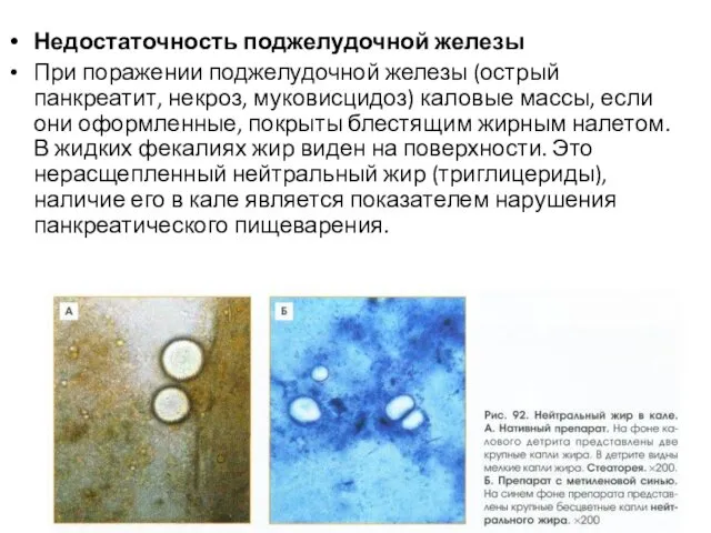 Недостаточность поджелудочной железы При поражении поджелудочной железы (острый панкреатит, некроз, муковисцидоз)