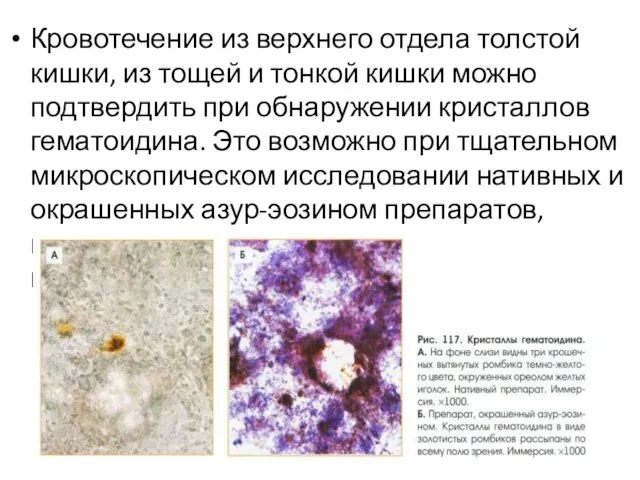 Кровотечение из верхнего отдела толстой кишки, из тощей и тонкой кишки