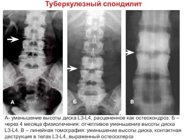 Туберкулезный спондилит А- уменьшение высоты диска L3-L4, расцененное как остеохондроз. Б