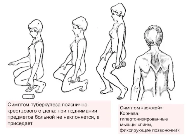 Симптом туберкулеза пояснично-крестцового отдела: при поднимании предметов больной не наклоняется, а