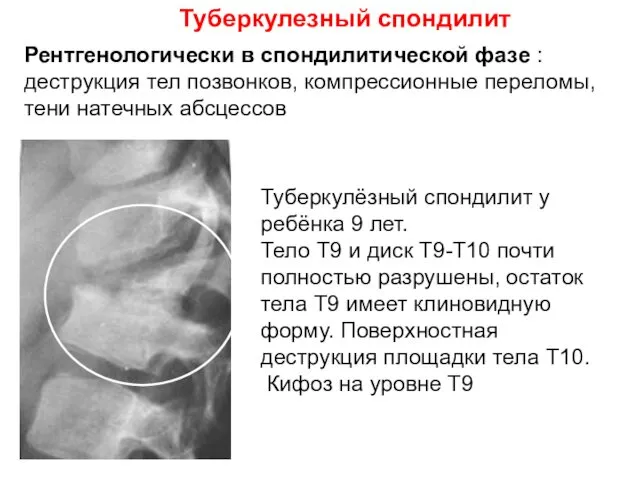 Туберкулезный спондилит Туберкулёзный спондилит у ребёнка 9 лет. Тело Т9 и