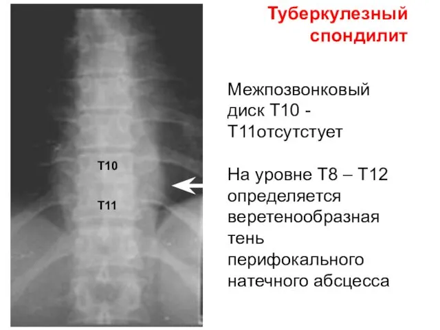 Туберкулезный спондилит Межпозвонковый диск Т10 - Т11отсутстует На уровне Т8 –