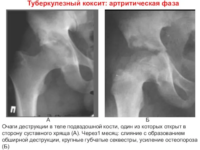 Туберкулезный коксит: артритическая фаза А Б Очаги деструкции в теле подвздошной