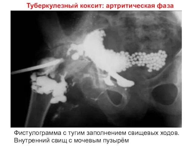 Туберкулезный коксит: артритическая фаза Фистулограмма с тугим заполнением свищевых ходов. Внутренний свищ с мочевым пузырём