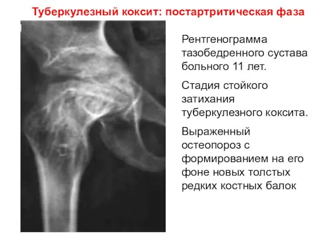 Туберкулезный коксит: постартритическая фаза Рентгенограмма тазобедренного сустава больного 11 лет. Стадия