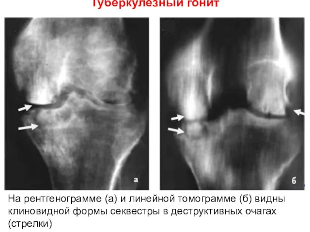 Туберкулезный гонит На рентгенограмме (а) и линейной томограмме (б) видны клиновидной