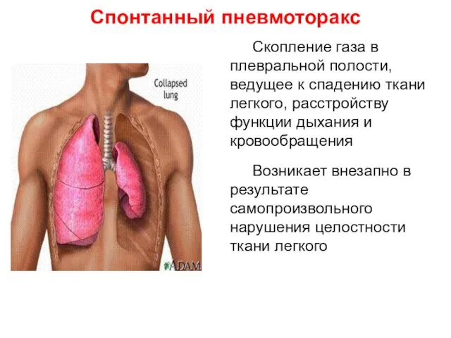 Скопление газа в плевральной полости, ведущее к спадению ткани легкого, расстройству