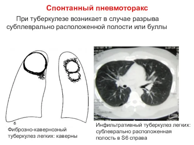 Спонтанный пневмоторакс При туберкулезе возникает в случае разрыва субплеврально расположенной полости