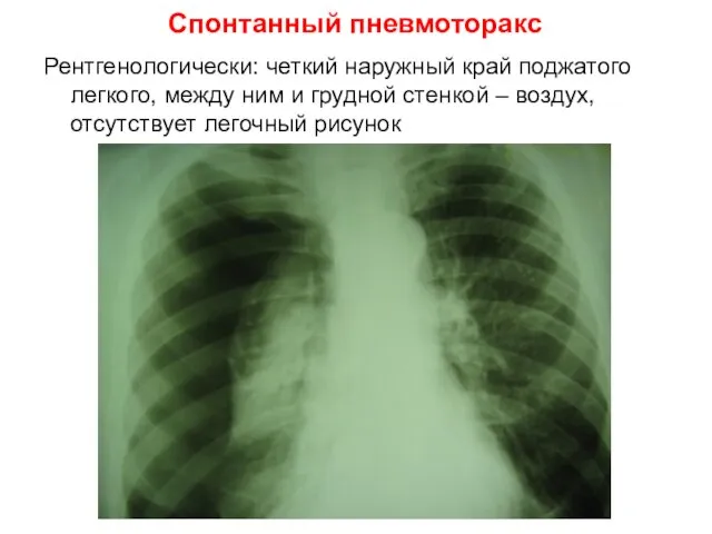 Рентгенологически: четкий наружный край поджатого легкого, между ним и грудной стенкой