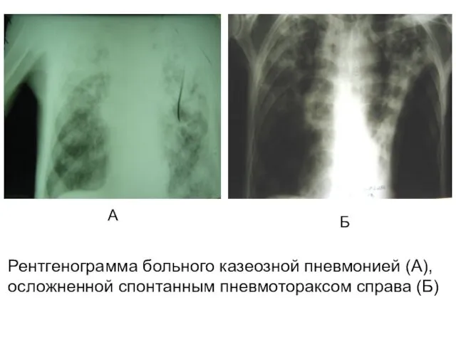 Рентгенограмма больного казеозной пневмонией (А), осложненной спонтанным пневмотораксом справа (Б) А Б