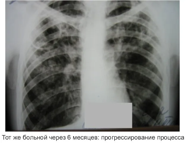 Тот же больной через 6 месяцев: прогрессирование процесса