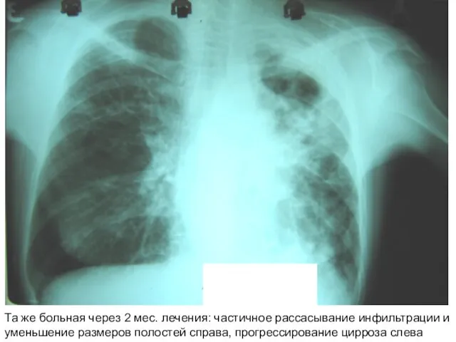 Та же больная через 2 мес. лечения: частичное рассасывание инфильтрации и