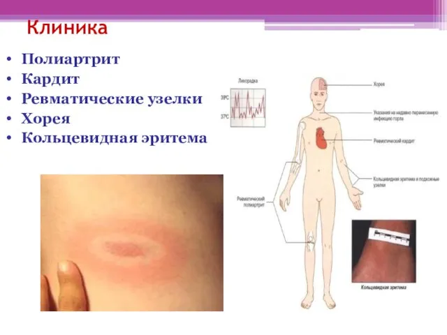 Клиника Полиартрит Кардит Ревматические узелки Хорея Кольцевидная эритема