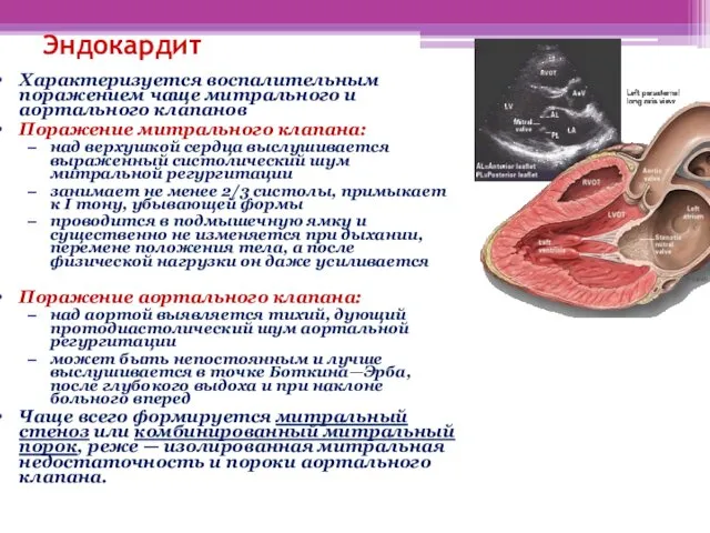 Эндокардит Характеризуется воспалительным поражением чаще митрального и аортального клапанов Поражение митрального