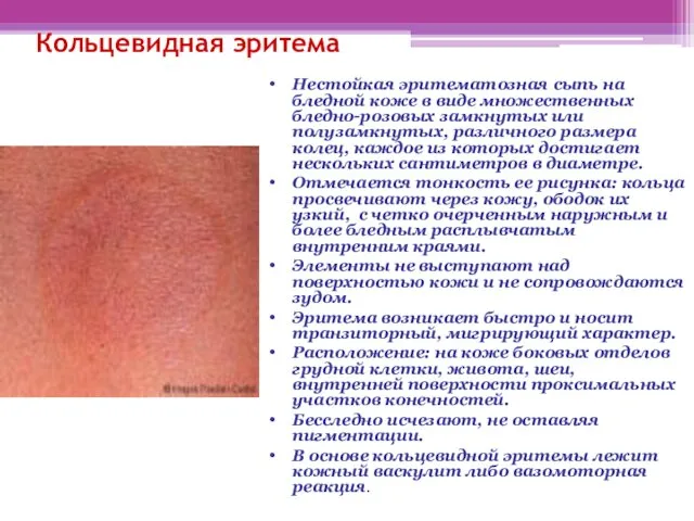 Кольцевидная эритема Нестойкая эритематозная сыпь на бледной коже в виде множественных