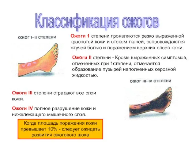 Ожоги 1 степени проявляются резко выраженной краснотой кожи и отеком тканей,