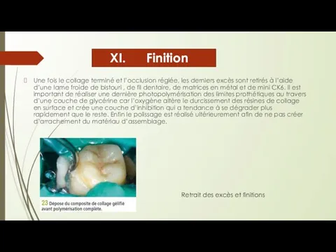 Finition Une fois le collage terminé et l’occlusion réglée, les derniers