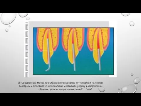 Инъекционный метод пломбирования каналов гуттаперчей является быстрым и простым,но необходимо учитывать